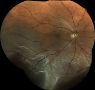 retinal-detachment eidon centervue