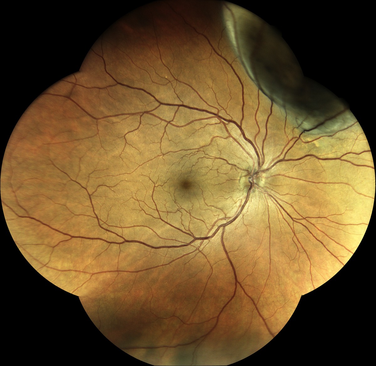 Eidon retina multimodal retinal imaging