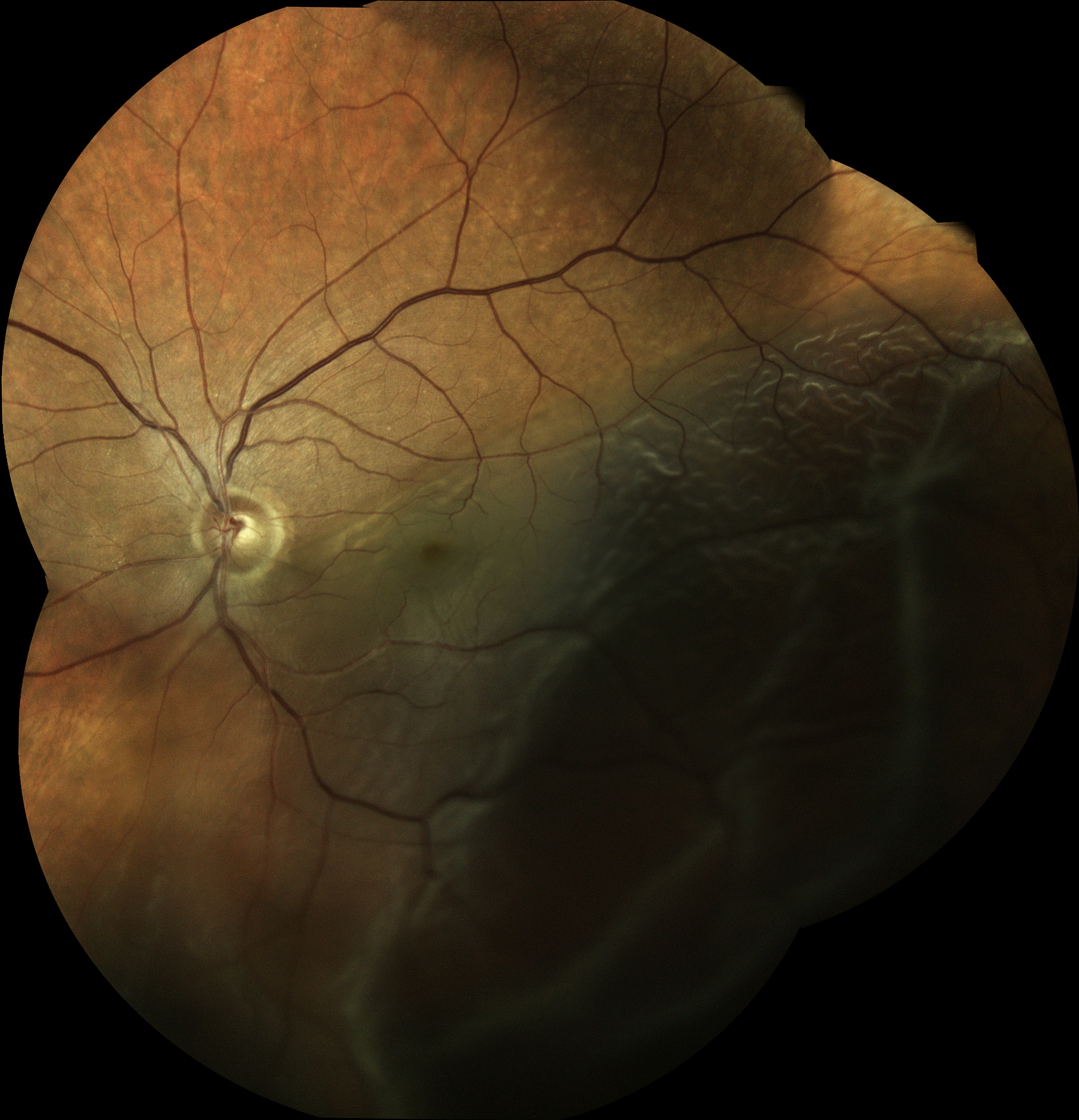  R Detachment / Courtesy of Dr Jean-Michel Muratet, Pamiers, France 