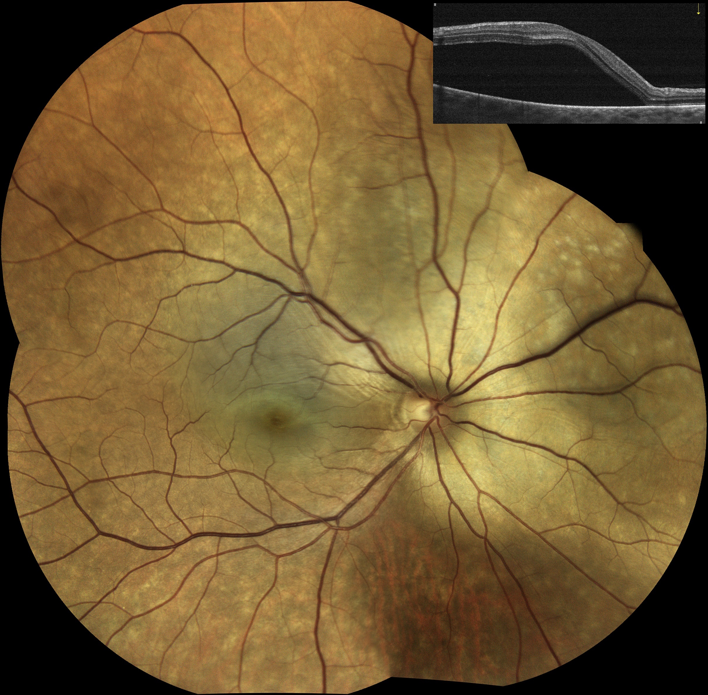  Metastasis / Courtesy of Dr Jean-Michel Muratet, Pamiers, France 
