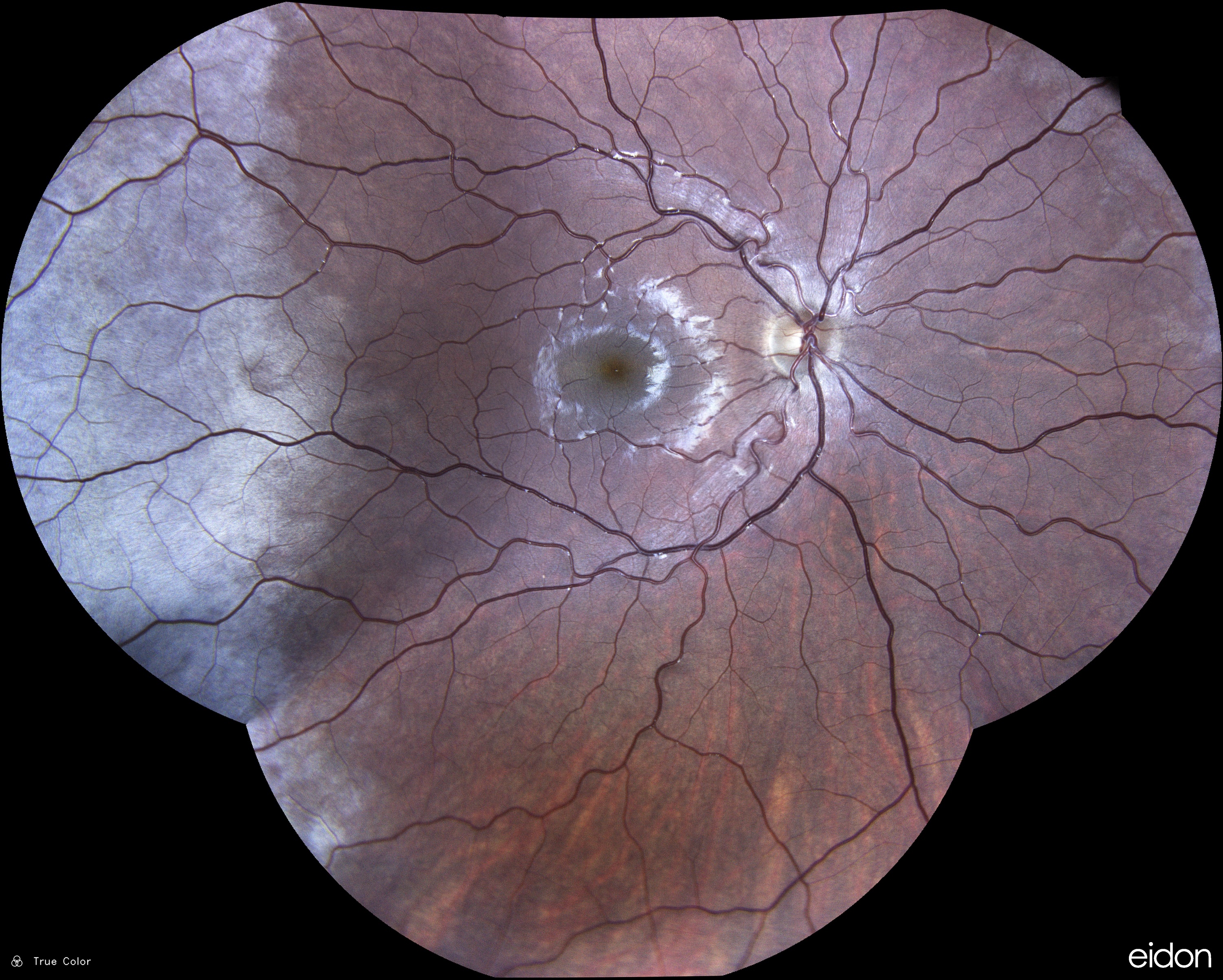  Tennis / Courtesy of Dr Jean-Michel Muratet, Pamiers, France 