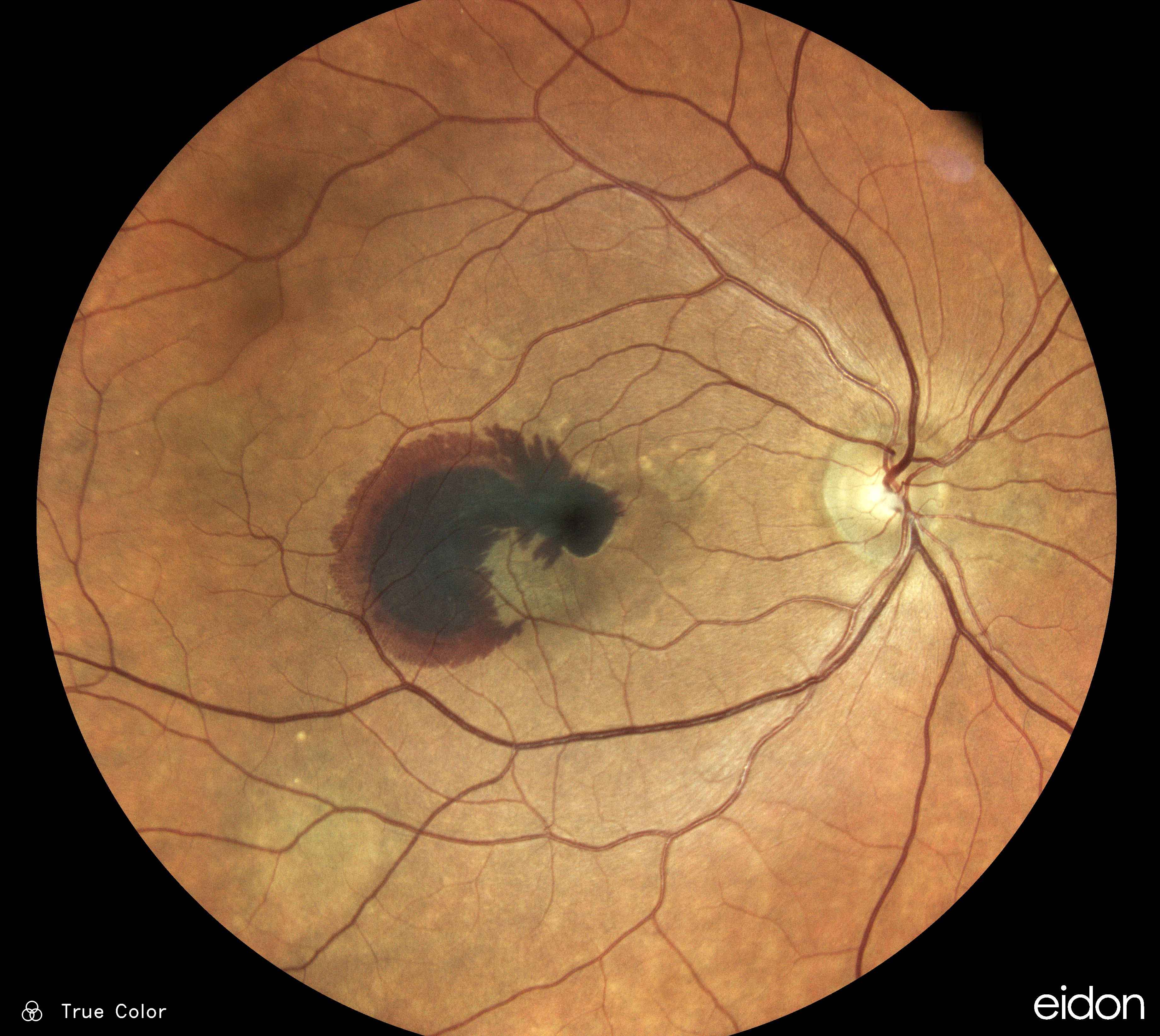  Hemorrhage / Dr Muratet 