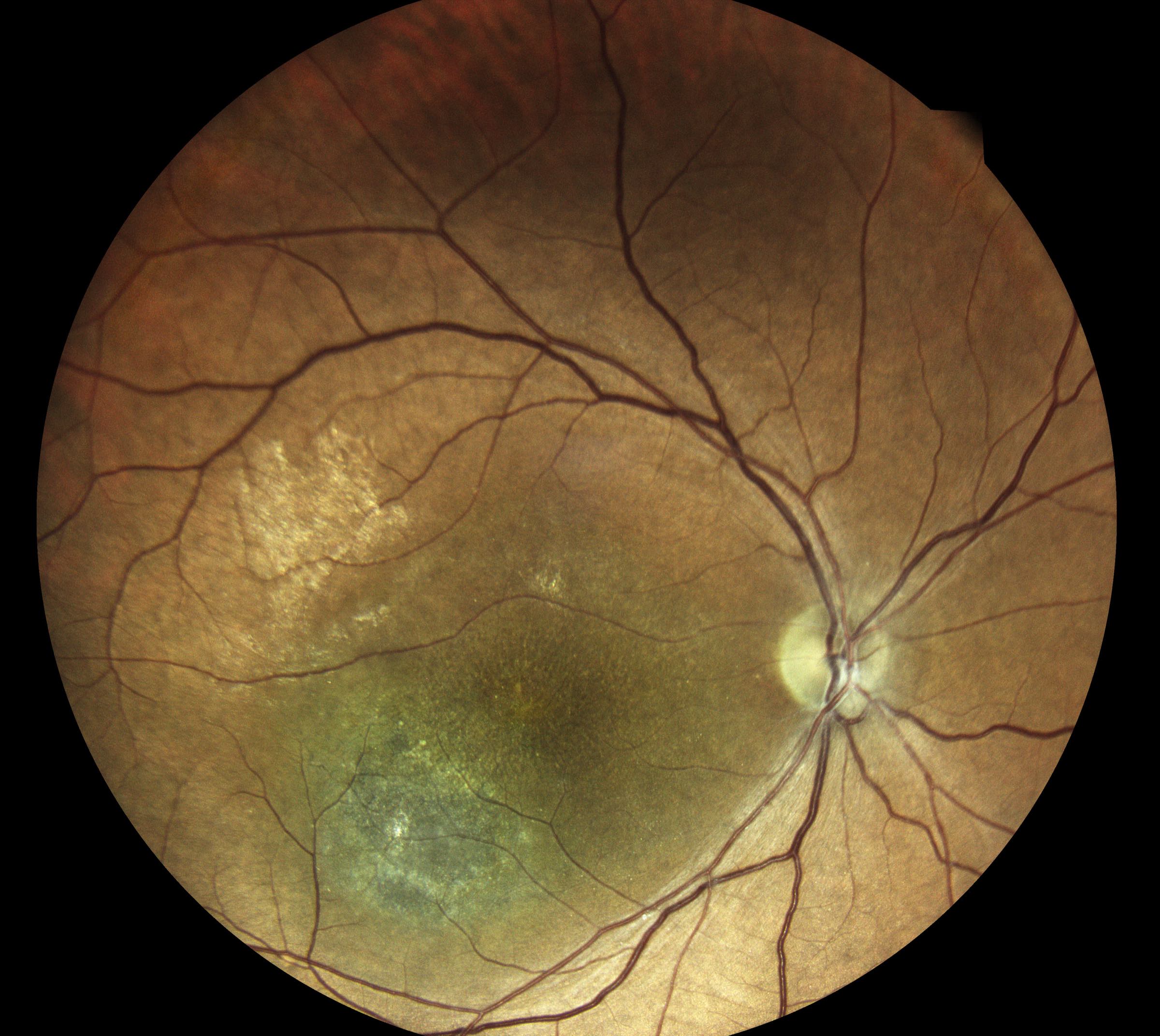 Истончение сетчатки. Ретиношизис дистрофия сетчатки. Буллезный ретиношизис. Макулярный ретиношизис. Артифакия, ретиношизис.