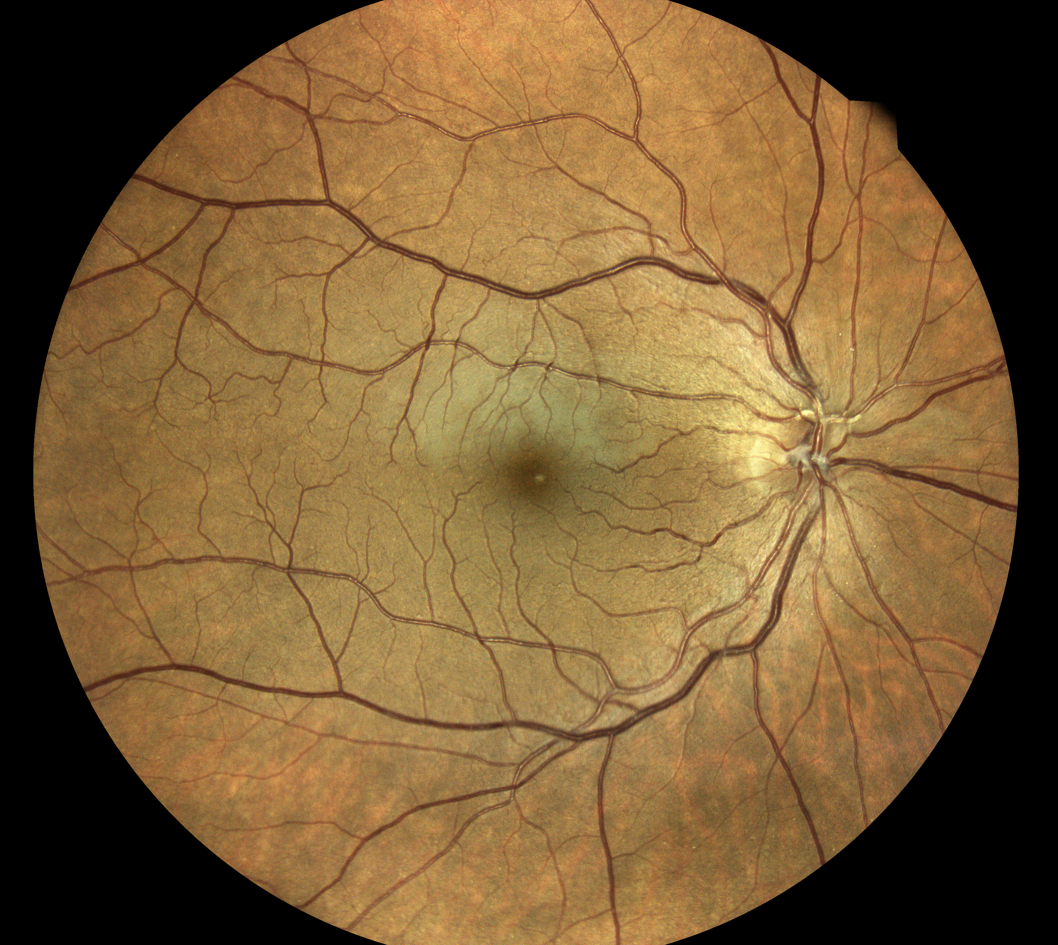 artery occlusion eidon muratet