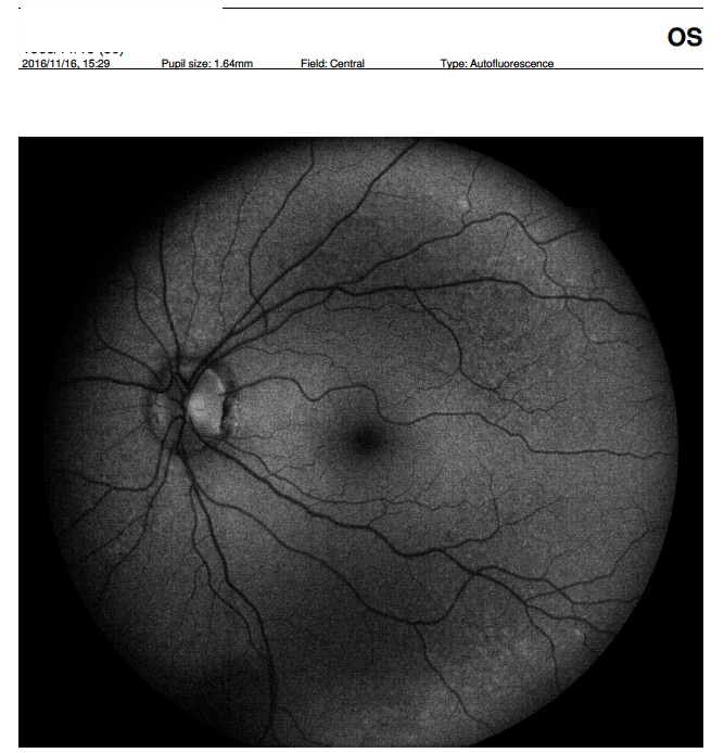 small pupil eidon autofluorescence centervue