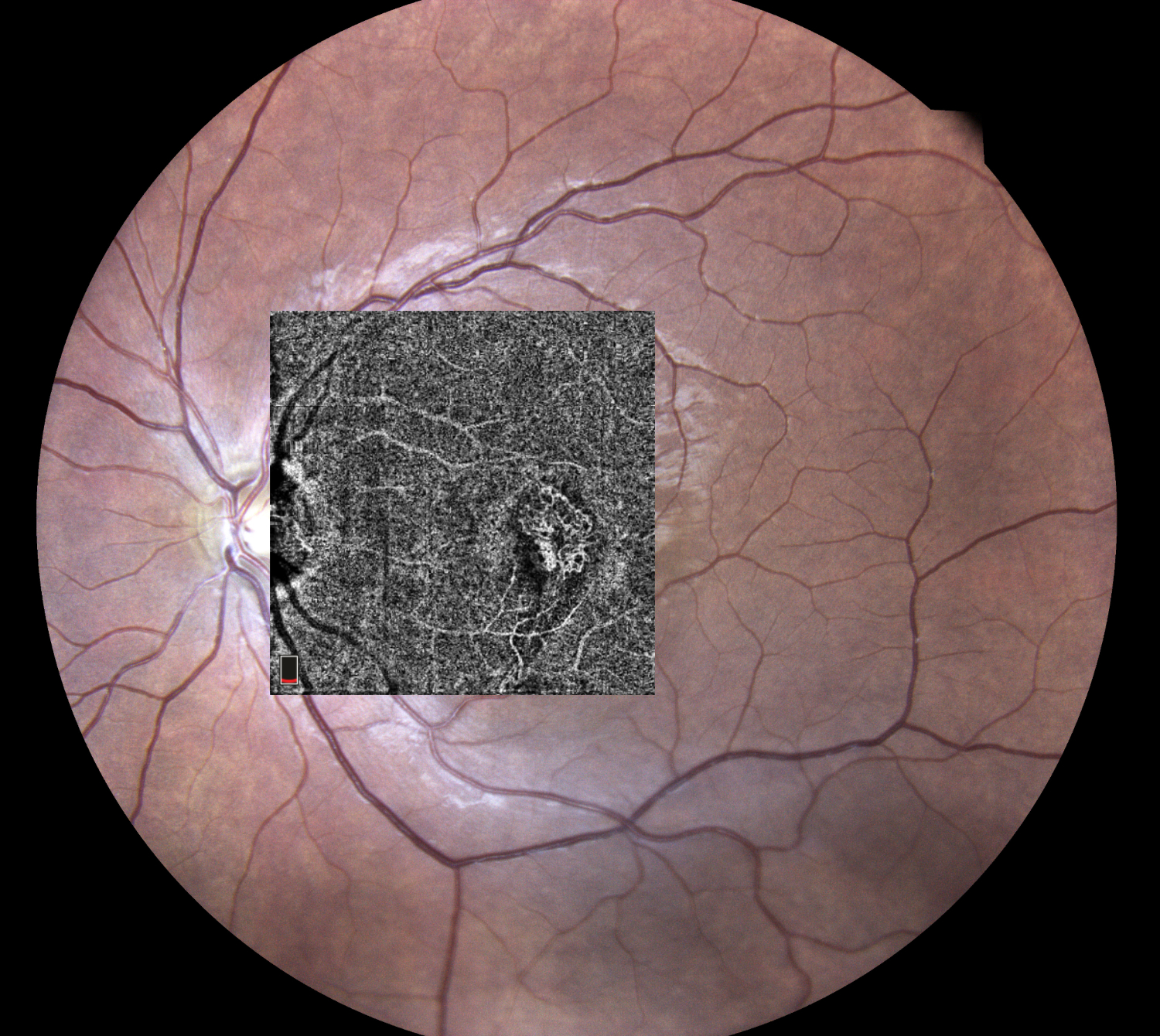 Traumatic Choroidal Rupture Associated With Neovascularization Traumatic Choroidal Rupture Associated With Neovascularization