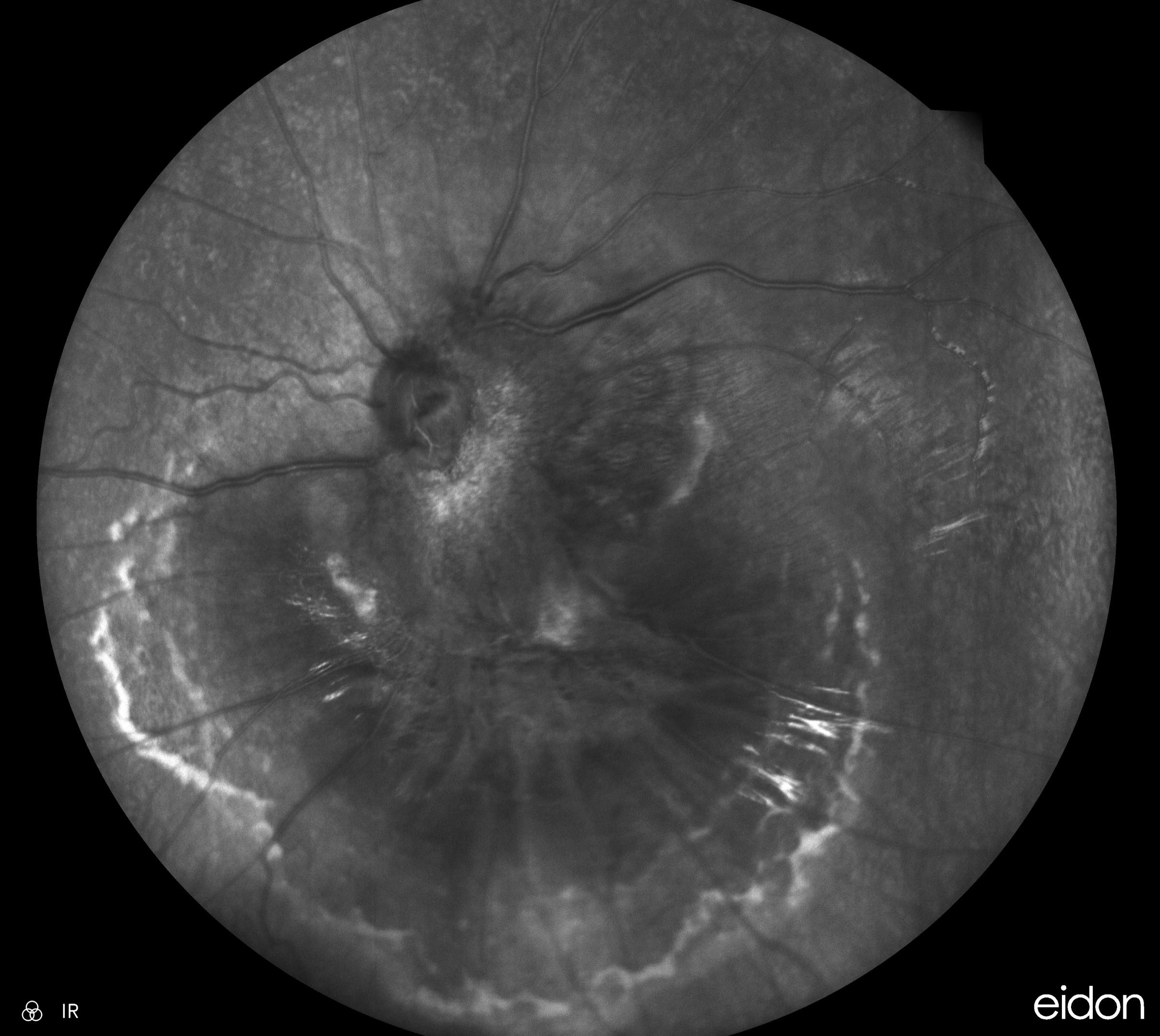 Combined Hamartoma of Retina and Retinal Pigment Epithelium