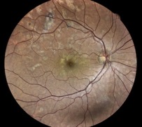 APMPPE eidon epitheliopathie en plaques epitheliopathy