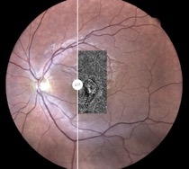 choroidal rupture neovascularization eidon