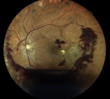 diabete retine retina