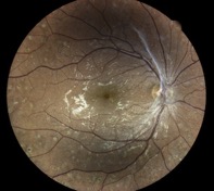 diabetic-retinopathy muratet pamiers eidon