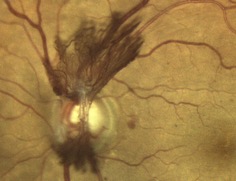 diabetic-retinopathy NEW VESSELS