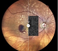 eidon-oct angiography optovue fundus amd 