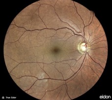 embole retine eidon embolism retina