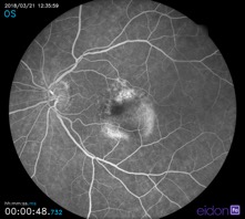 fluorescein angiography eidon