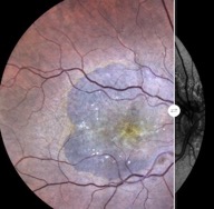 geographic atrophy retinal eidon centervue