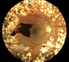 hemorragie retine diabte panphotocoagulation