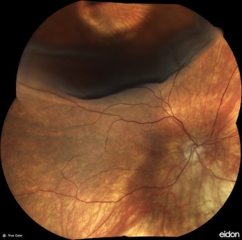 retinal-detatchment-hole-mini