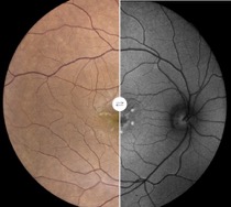 stargardt disease eidon autofluorescence