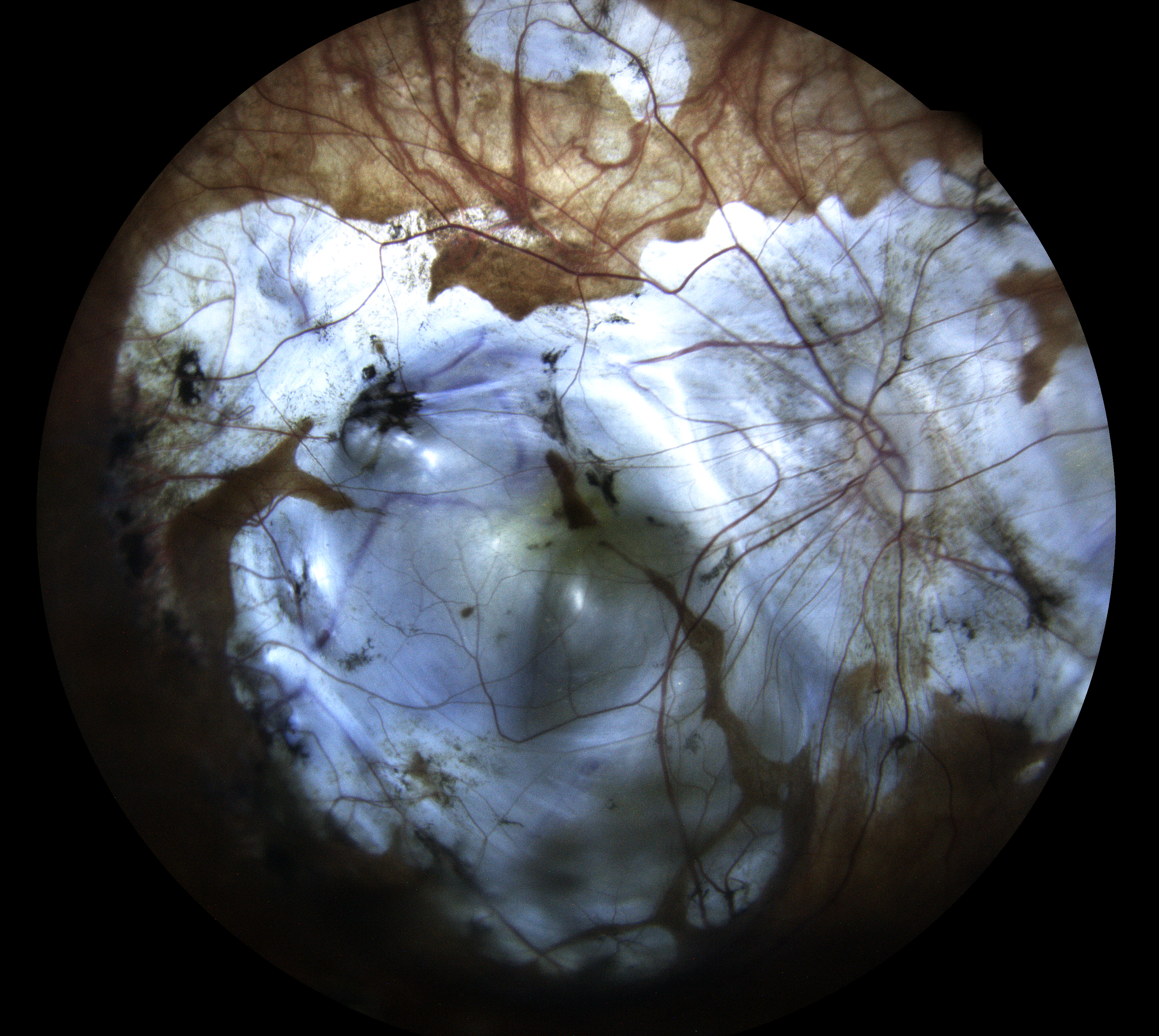 myopia eidon muratet retina