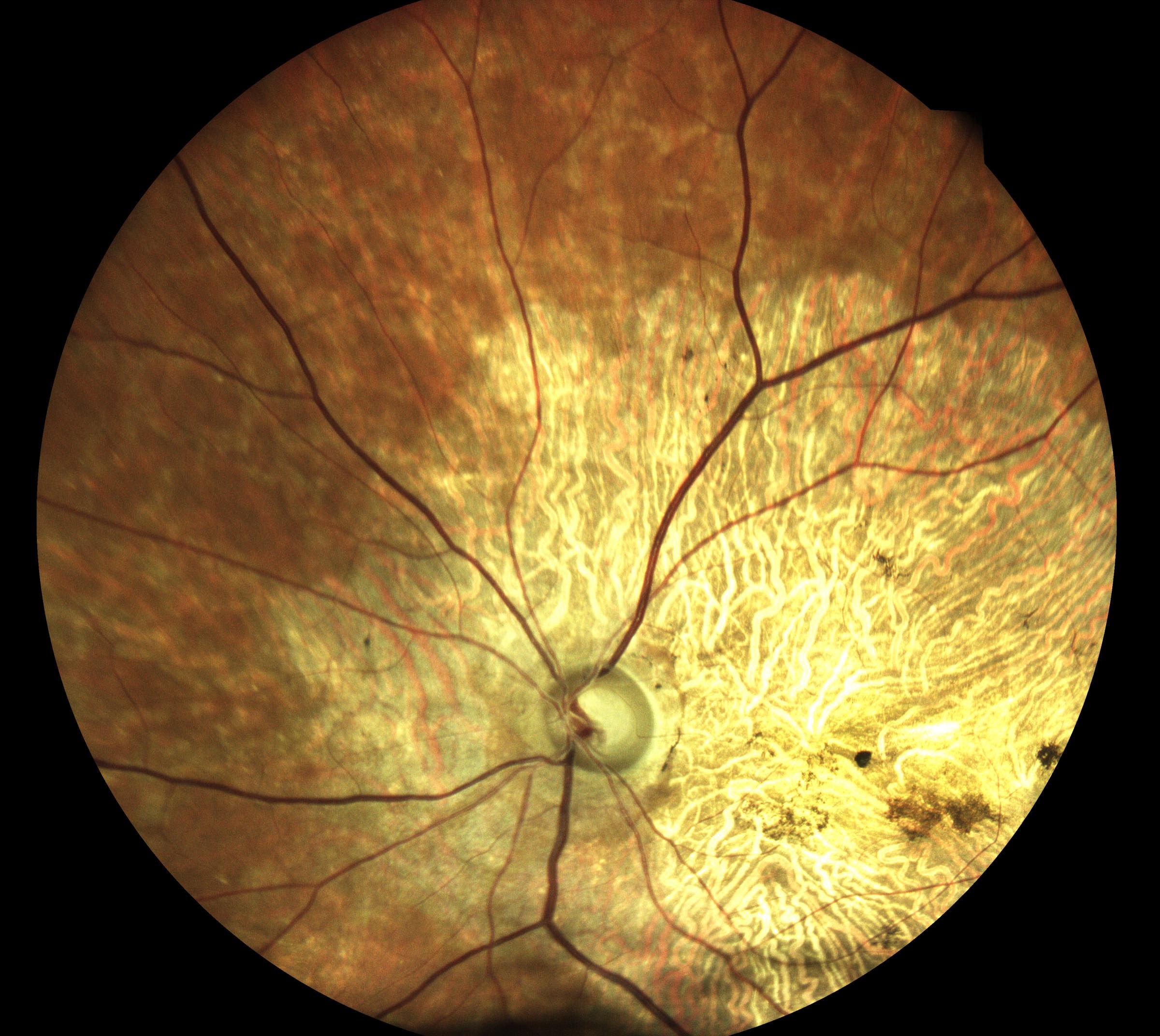 Stargardt Disease (Eidon)